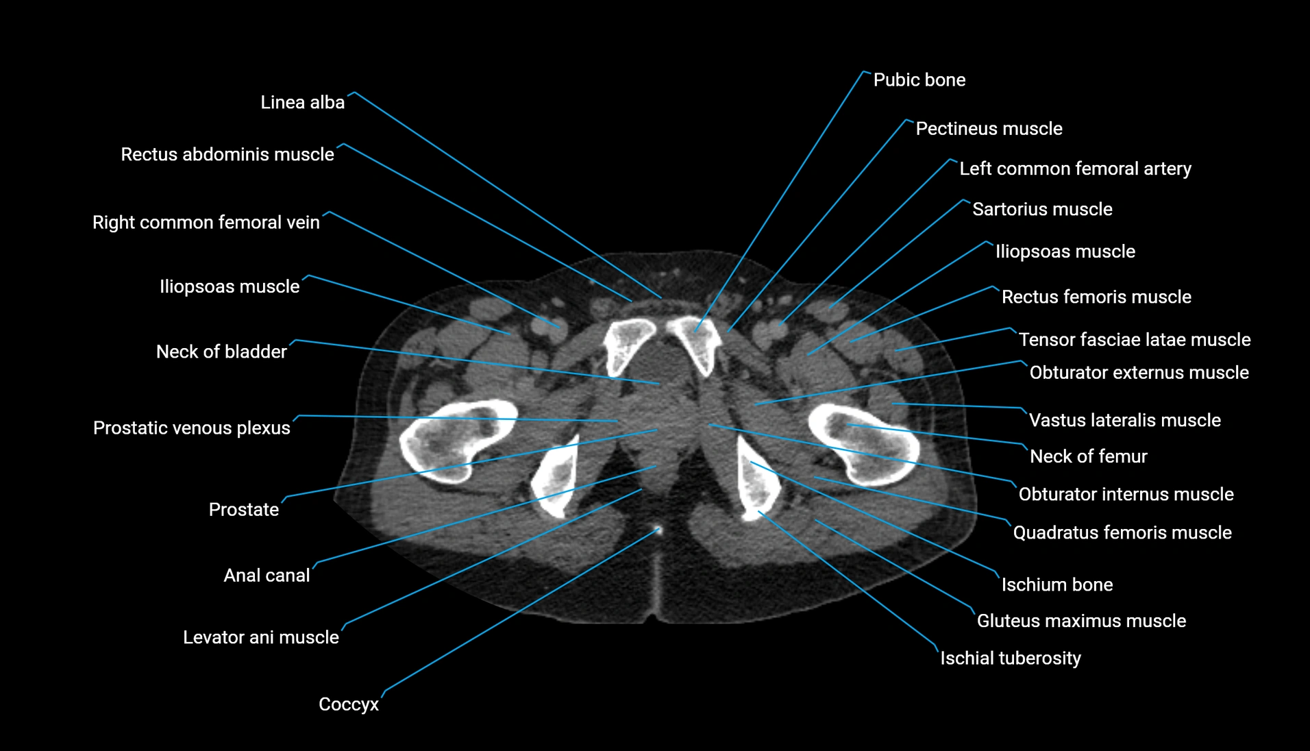 CT urogram axial cross sectional anatomy  labelled radiology image-00250.webp